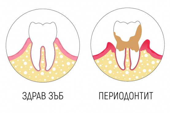 Здрав зъб и периодонтит