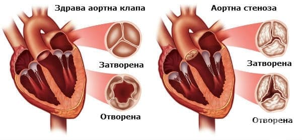 Аортна стеноза