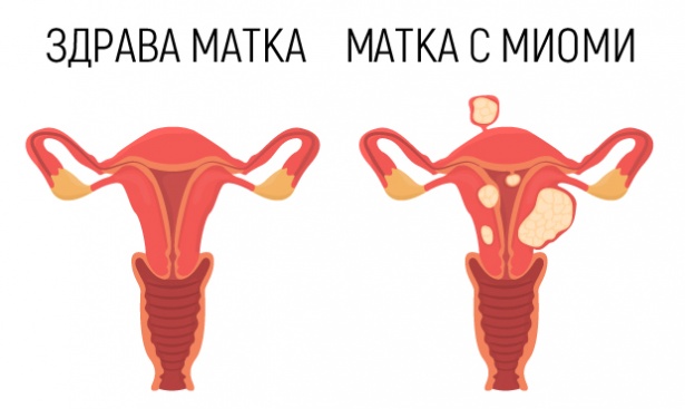Матка с миоми