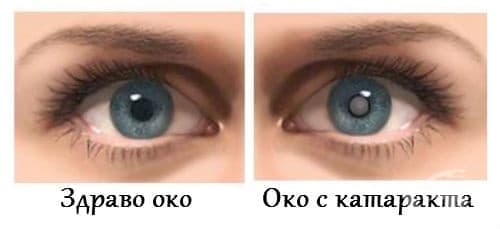 Здраво око и око с катаракта