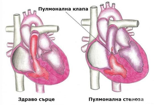Пулмонална стеноза
