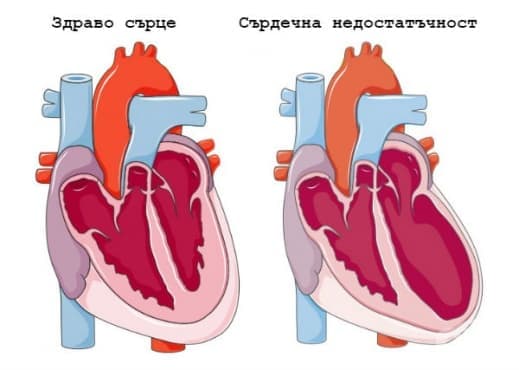 Здраво сърце и сърдечна недостатъчност