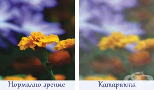 Нормално зрение и катаракта