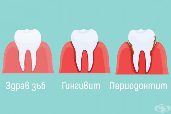 Дентални заболявания