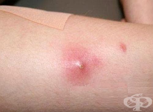 Използвайте 9 домашни средства за лечение на циреи - изображение