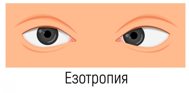 Езотропия - изображение