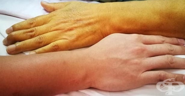 Пожълтяване на кожата и очите - изображение