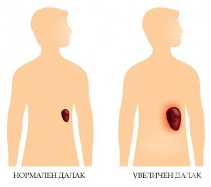 Увеличен далак - изображение