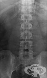Рентгеново изследване на лумбалните прешлени - изображение