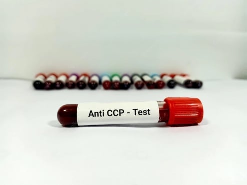 Антитела срещу цикличен цитрулиниран пептид (анти-ССР) - изображение