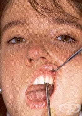 Перкусия на зъб - изображение