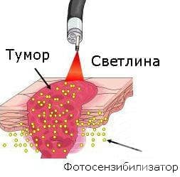 Фотодинамична терапия - изображение