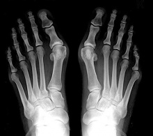 M20.1 Hallux valgus ()