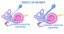 H81.0   Meniere