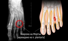 G57.6   n. plantaris