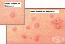 Какви са симптомите и признаците при варицела?