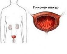 Какви видове цистит има?