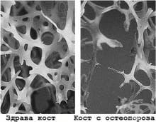 Колко типа остеопороза има?